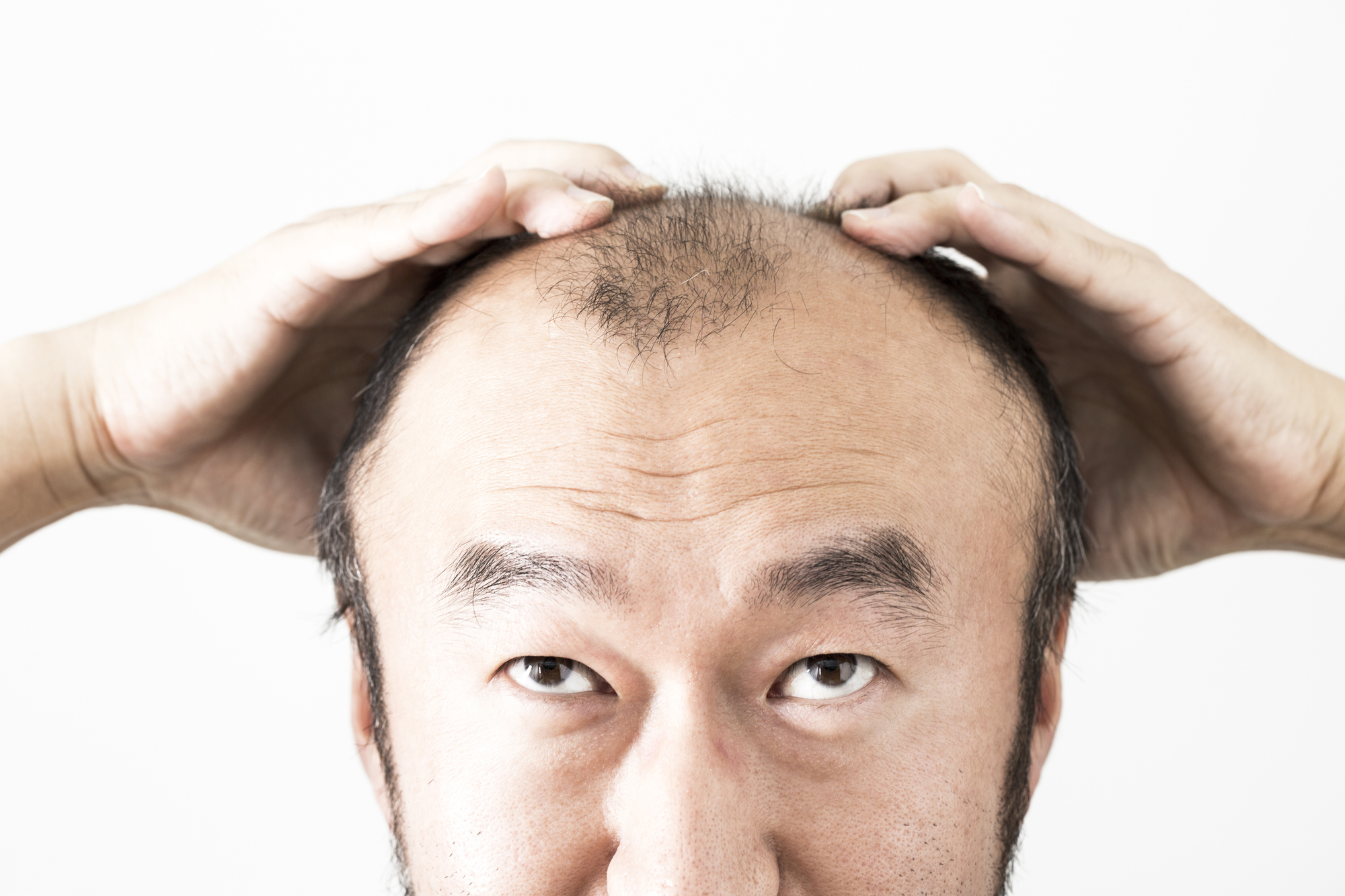 AGA治療っていつまで行えばいいの？治療期間や減薬のタイミングを解説